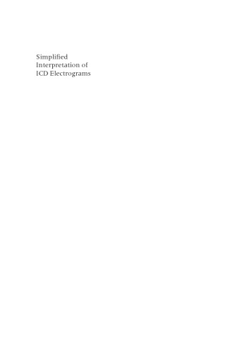 Simplified Interpretation of ICD Electrograms