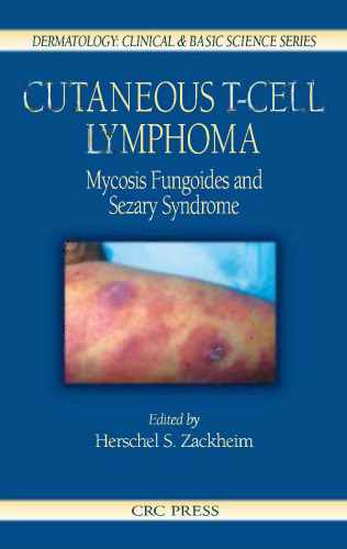 Cutaneous T-cell lymphoma : mycosis fungoides and Sézary syndrome