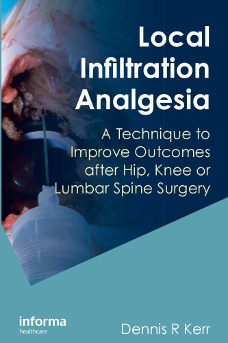 Local infiltration analgesia: a technique to improve outcomes after hip, knee, and lumbar spine surgery