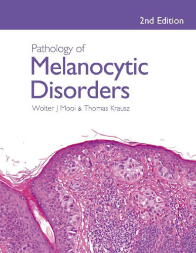 Pathology of Melanocytic Disorders