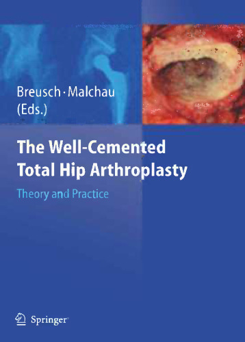 The Well-Cemented Total Hip Arthroplasty: Theory and Practice