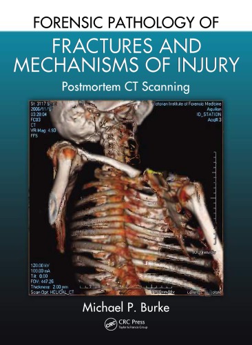 Forensic Pathology of Fractures and Mechanisms of Injury : Postmortem CT Scanning