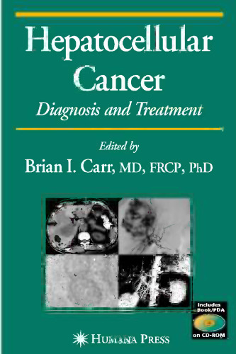 Hepatocellular Cancer: Diagnosis and Treatment