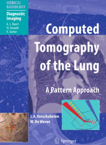 Computed Tomography of the Lung: A Pattern Approach