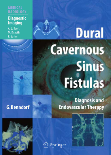 Dural Cavernous Sinus Fistulas: Diagnostic and Endovascular Therapy