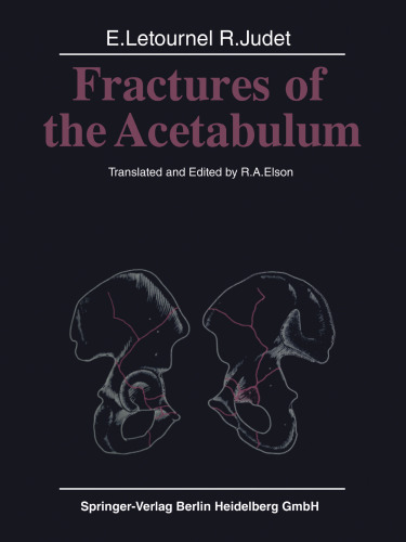 Fractures of the Acetabulum