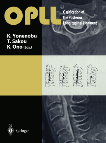 OPLL: Ossification of the Posterior Longitudinal Ligament