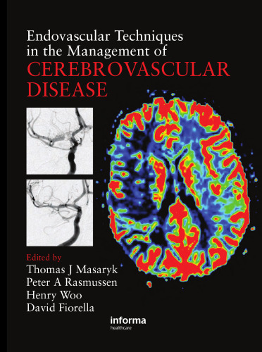 Endovascular Techniques in the Management of Cerebrovascular Disease