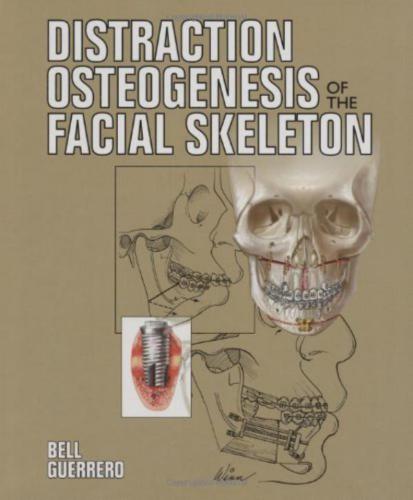 Distraction Osteogenesis of the Facial Skeleton