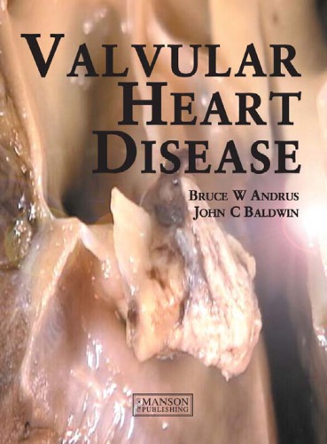 Valvular Heart Disease