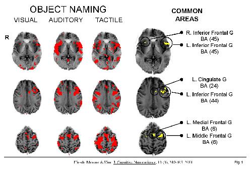 Neuroimagery