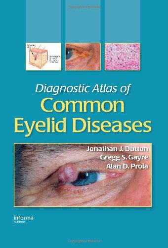 Diagnostic Atlas of Common Eyelid Diseases Informa Healthcare