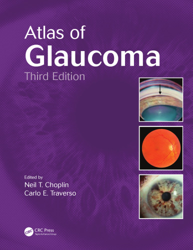 Atlas of Glaucoma, Third Edition