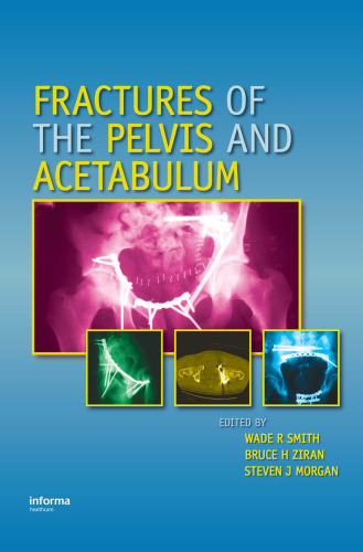 Fractures of the Pelvis and Acetabulum