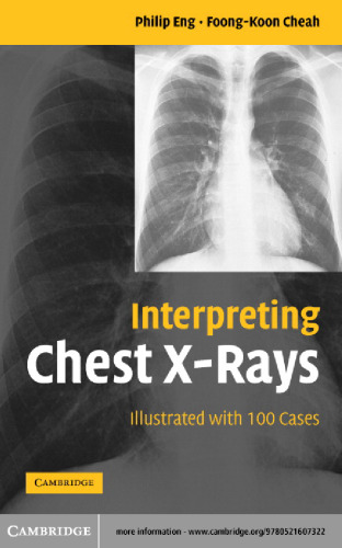 Interpreting Chest X-Rays Illustrated with 100 Cases