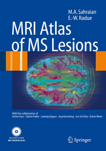 MRI Atlas of MS Lesions