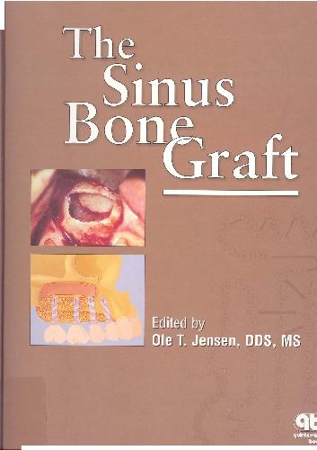 The Sinus Bone Graft