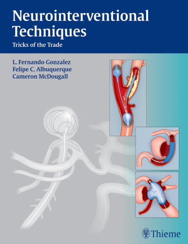 Neurointerventional Techniques: Tricks of the Trade