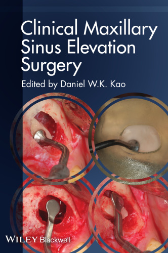 Clinical Maxillary Sinus Elevation Surgery