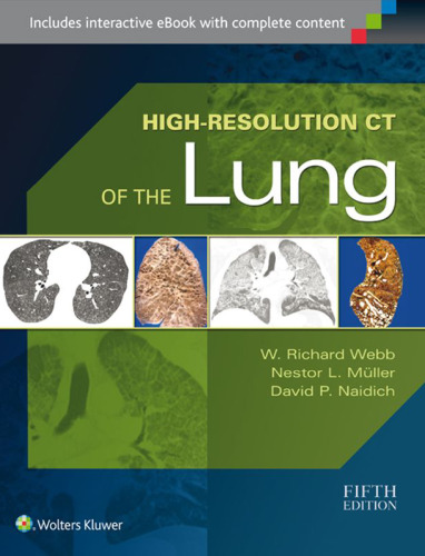 High-Resolution CT of the Lung