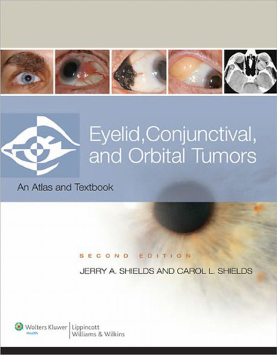 Eyelid, conjunctival, and orbital tumors : atlas and textbook