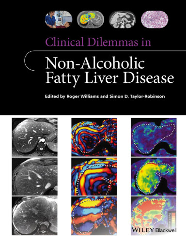 Clinical Dilemmas in Non-Alcoholic Fatty Liver Disease (Clinical Dilemmas