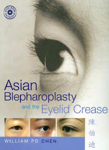 Asian Blepharoplasty and the Eyelid Crease