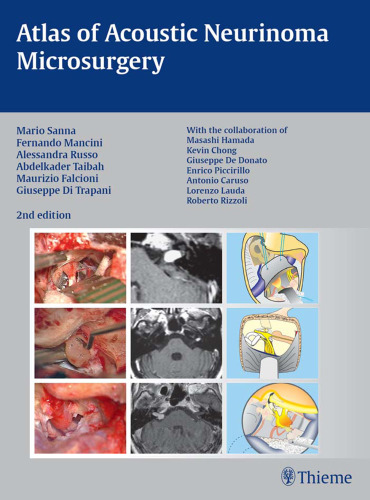 Atlas of Acoustic Neurinoma Microsurgery: . Zus.-Arb.: Mario Sanna Essam Saleh, Benedict Panizza, Alexandra Russo, Abdel TaibahWith the collaboration of Refik Caylan, Fernando Mancini