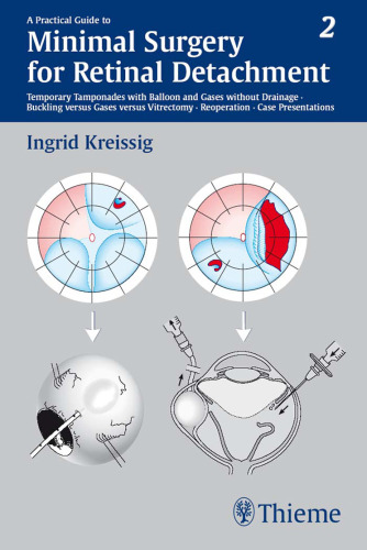 Practical Guide to Minimal Surgery for Retinal Detachment Vol. II: Minimal Surgery for Retinal Detachment: Temporary Tamponades with Balloon and Gases without Drainage Buckling versus Ga