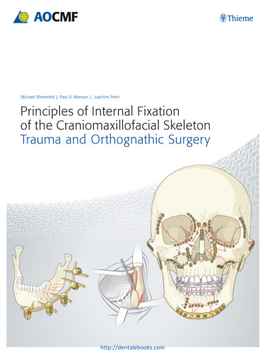 Principles of Internal Fixation of the Craniomaxillofacial Skeleton: Trauma and Othognathic Surgery