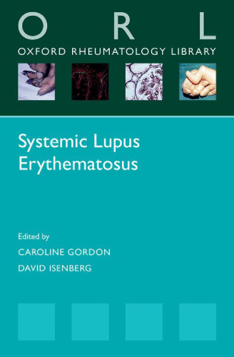 Systemic lupus erythematosus