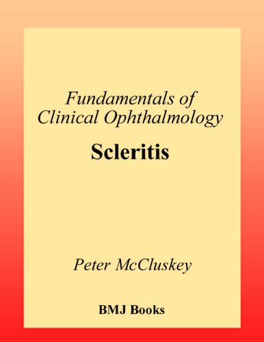 Scleritis