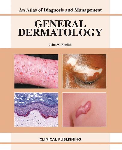 GENERAL DERMATOLOGY AN ATLAS OF DIAGNOSIS AND MANAGEMENT