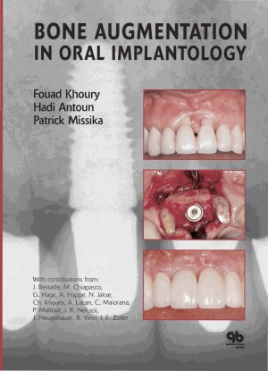 Bone Augmentation in Oral Implantology