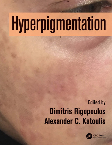 Hyperpigmentation