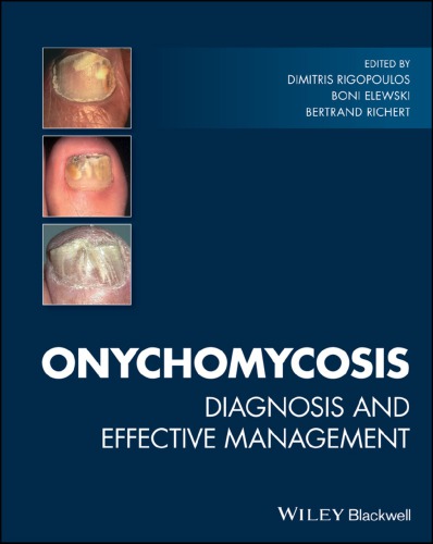 Onychomycosis : diagnosis and effective management