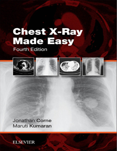 Chest X-Ray Made Easy