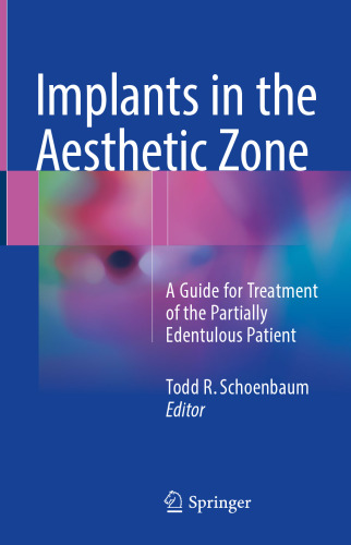 Implants in the Aesthetic Zone: A Guide for Treatment of the Partially Edentulous Patient