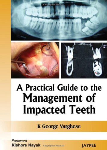 A Practical Guide to the Management of Impacted Teeth