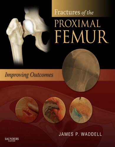 Fractures of the Proximal Femur: Improving Outcomes