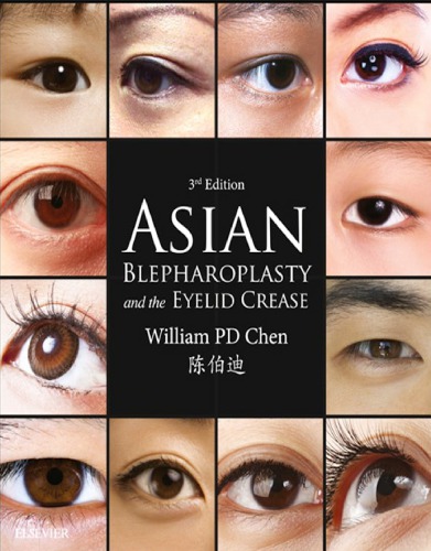 Asian Blepharoplasty and the Eyelid Crease