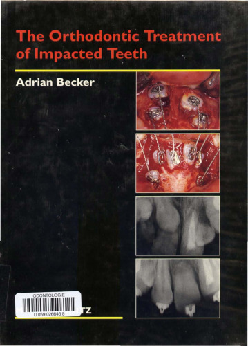 Orthodontic Treatment of Impacted Teeth