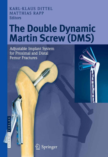 The Double Dynamic Martin Screw (DMS): Adjustable Implant System for Proximal and Distal Femur Fractures