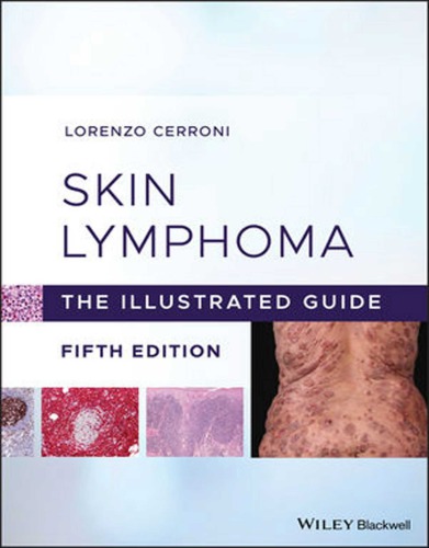 Skin lymphoma: the illustrated guide