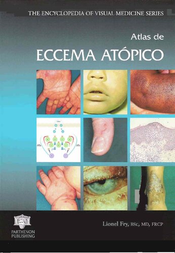 Atlas De Eccema Atopico