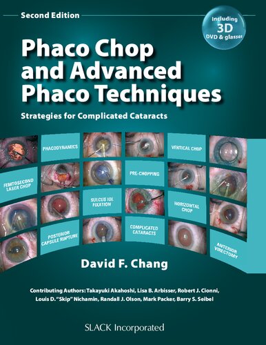 Phaco Chop and Advanced Phaco Techniques: Strategies for Complicated Cataracts