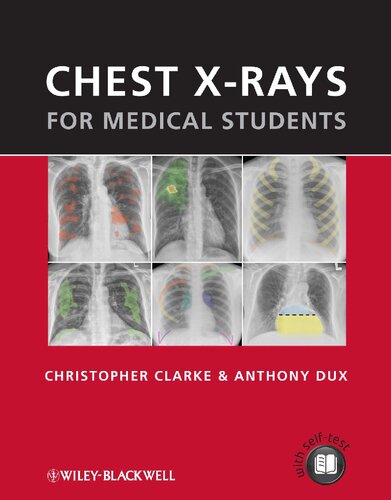 Chest X-rays for Medical Students