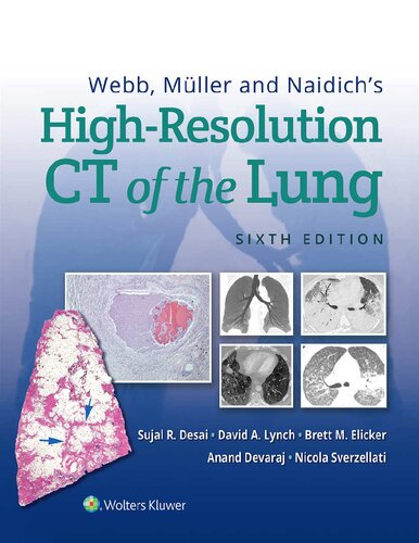 Webb, Muller and Naidich's High-Resolution CT of  the Lung