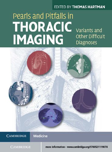 Pearls and Pitfalls in Thoracic Imaging: Variants and Other Difficult Diagnoses