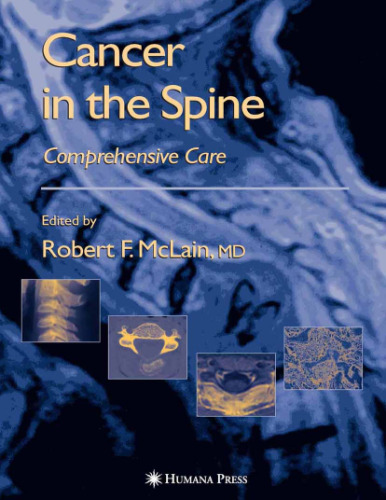 Cancer in the Spine: Comprehensive Care 